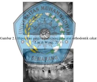 Gambar 2.1 Hiperplasi gingiva pada pengguna alat orthodontik cekat 