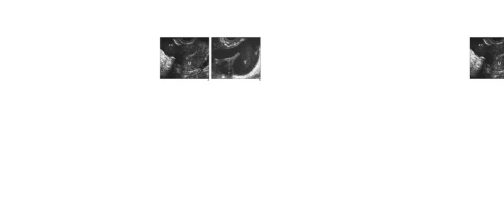Gambar 6: Pemeriksaan USG. A: Pada ultrasound transvaginal, tampak gambaran complex free fluid 