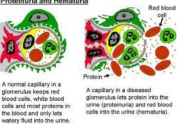 Gambar 7.proses terjadinya proteinuria dan hematuria  14