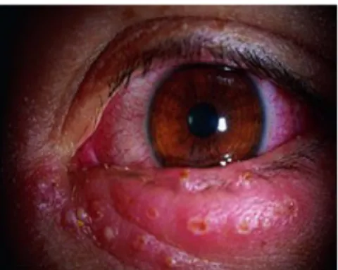 Gambar 15 : Herpes Zoster Ophthalmica