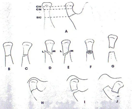 Gambar 5.Klasifikasi menurut Lindahl (Fonseca, 1997)