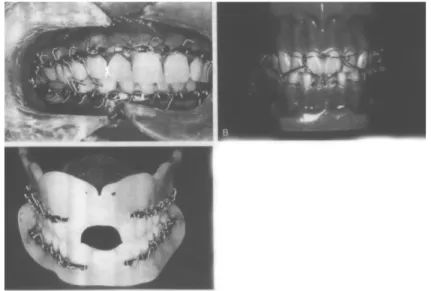 Gambar 6. Pemakaian arch bar dan splint pada fraktur kondilus (Fonseca, 1997)
