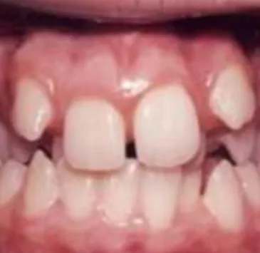 Gambar 2 Anak dengan wajah adenoid adalah ciri khas anak  pernapasan mulut (Sumber: Silva M, Manton D