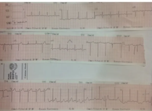 Gambar	1.	Gambaran	EKG	dengan	interpretasi	 Sinus	aritmia	dengan	PAC	dan	LVH. 	 	 	 Gambar	2.		Foto	Thoraks	cardiomegali,	 pneumonia,	dan	pleura	reaction	dextra 	 	