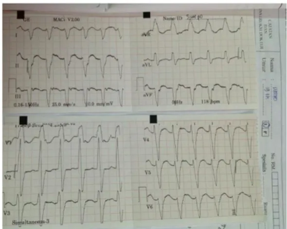 Gambar 1. Gambaran EKG dengan interpretasi  RBBB lead Avf, V4-V6 