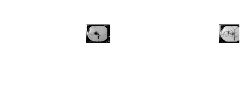 Gambar 9a. Gambaran angiografi JNA sebelum embolisasi (9)