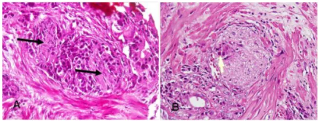 Gambar 3.  Pola Gleason 5.  A. Gambaran sel tumor  yang  padat;  B.  Gambaran  sel  tumor  yang  tersusun  tunggal  dan  seperti  pita;  C  dan  D