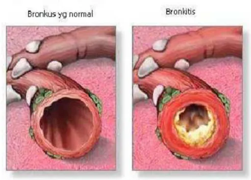 Gambar 4. Perbedaan bronkus yang normal 