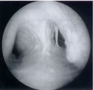 Gambar 6. Menunjukkan perubahan inflamasi tuberkulosis dengan serangkaian  sekresi terlihat pada batang utama bronkus kanan