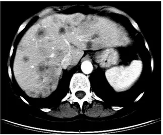 Gambar  2.6 :  Tomografi  komputer  toraks  potongan  aksial  dengan  kontras intravena menunjukkan massa paru kiri yang besar dan hilus, dengan invasi dari arteri pulmonalis kiri.