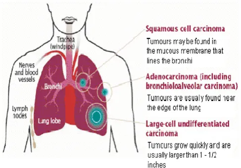 Gambar 2.1 : Tipe Kanker Paru ( Global Lung Cancer Coalition )