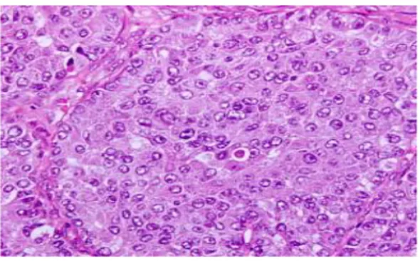 Gambar 2.5. Karsinoma sel besar (Travis, 2011)  2.2.4.4.  Karsinoma sel besar  