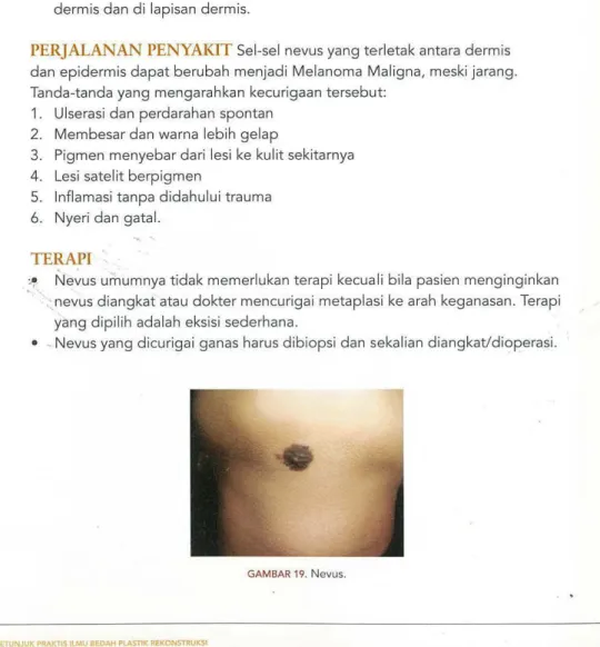 GAMBAR 19. N evus. 
