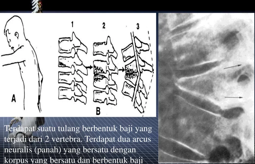 Gambar 1. Spondilitis Tuberkulosa