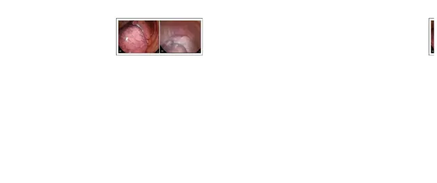 GAMBAR 2. poudrage Talk selama pleuroscopy sisi kanan. Pleuroscopy dengan bedak poudrage dilakukan di hemithorax yang tepat untuk mencapai pleurodesis pada pasien dengan adenokarsinoma metastatik dari paru-paru (lobus kanan atas) dan berulang gejala kanan 