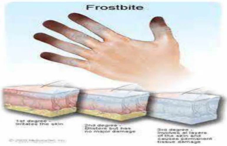 Gambar 4. Frostbite 