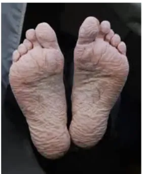 Gambar 5. Trench foot 