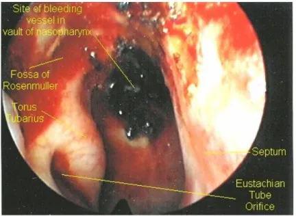 Gambar  9.  Gambaran  sagital  MR  pada  solitary  fibrous  tumor  dengan  masa  tumor  dan  epistaksis  dan  Gambaran  angiogram  angiofibroma  juvenil  dengan  obstruksi  hidung dan epistaksis 