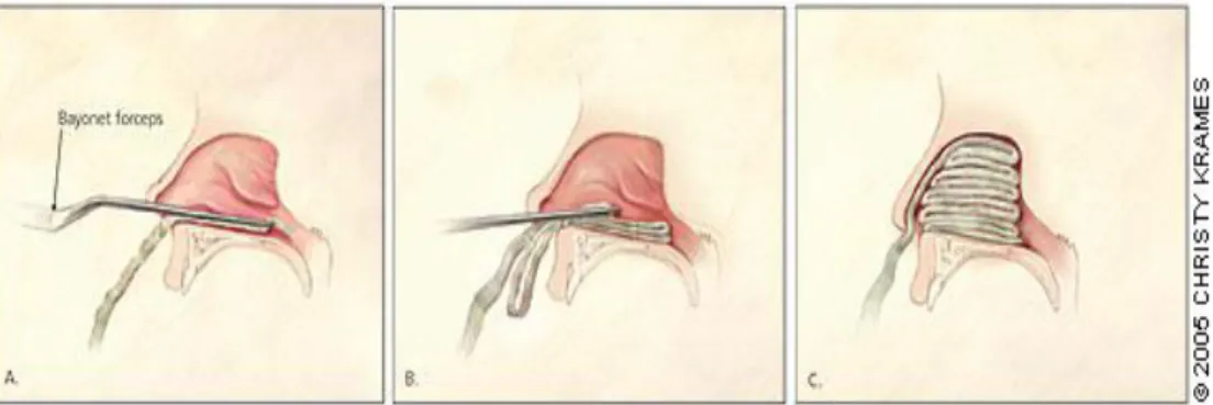Gambar 12. Tampon Anterior 