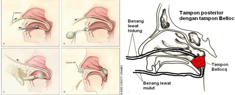 Gambar 14. Tampon Bellocq 