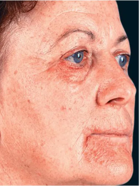 Gambar 9. Dermatitis perioral 