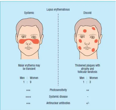 Gambar 5.   karakteristik  perbedaan  sistemik  lupus  eritomatosus  dan  diskoid  lupus  eritematosus 11