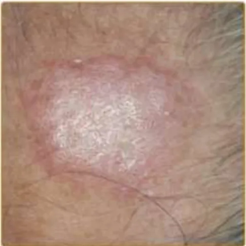 Gambar 9.   Lupus eritematosus klasik diskoid. Ditandai dengan plak eritematosus pada  bagian dahi menunjukkan hiperkeratosis dan menekankan pada orifisium  folikel  pada  laki-laki  usia  60  tahun  dengan  riwayat  mengalami  lupus  eritematosus kutaneus