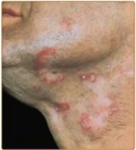 Gambar  10.      Lupus  eritematosus  diskoid.  Plak  eritematosus  pada  leher  dan  wajah,  berbatas  tegas,  bentuk  bulat  sampai  oval,  sedikit  meninggi