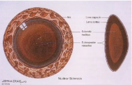 Gambar 3. Sklerosis nukleus pada katarak nuklear