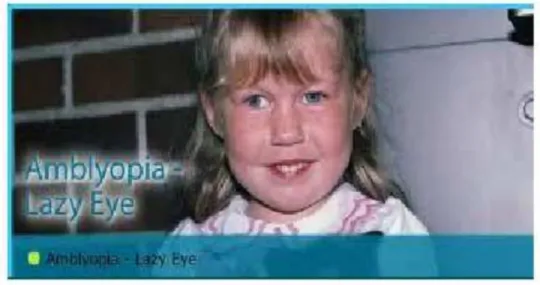 Gambar 4. Ambliopia-lazy eye.