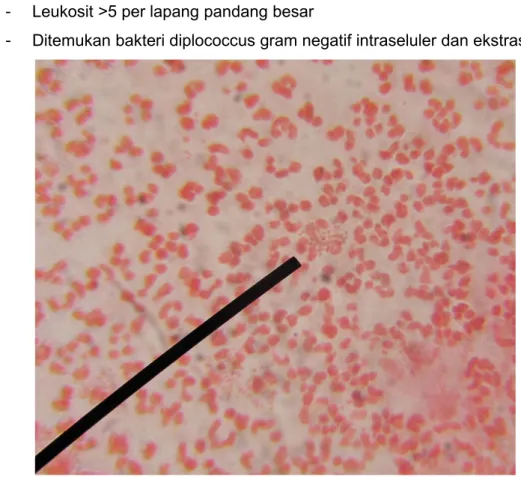 Gambar 4. Kuman Diplococcus Gram Negatif Intraseluler dan ekstraseluler