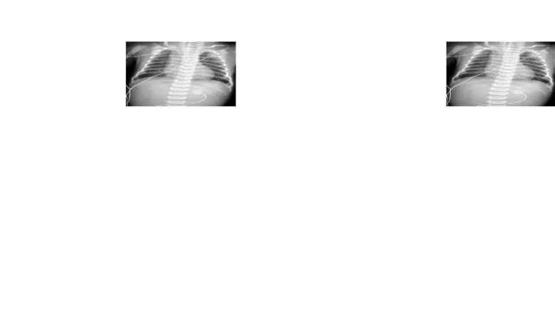 Gambar 2. Gambaran PA Atresia Esofagus tanpa fistulaGambar 2. Gambaran PA Atresia Esofagus tanpa fistula 1111
