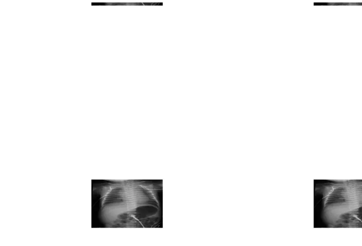 Gambar 4. Gambaran PA Atresia Esofagus dengan Fistula DistalGambar 4. Gambaran PA Atresia Esofagus dengan Fistula Distal 1414