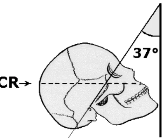 Gambar  9.  Foto  polos  kepala  posisi  Waters  (submento-oksipital)  untuk  melihat  lebih jelas struktur tulang-tulang wajah 1/3 tengah dan sinus maksilaris