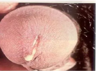 Gambar 1. Uretritis Gonore Akuta dengan Duh Tubuh Uretra yang Purulen 