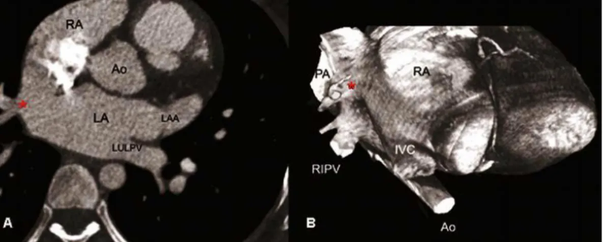 Gambar 9. A. Gambaran CT Aksial ASD sinus venosus dengan anomali  vena pulmonalis  kanan atas mengalir ke persimpangan SVC / RA 