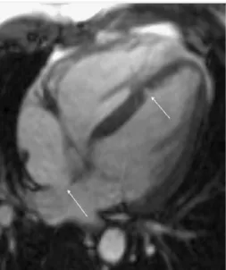 Gambar 10. Gambaran atrial Septal defek tipe sekundum (panah kiri) dan ventrikel  septal defek (panah kanan)