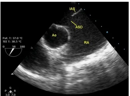 Gambar TEE dalam tampilan axis pendek menunjukkan aorta (Ao),  bagian  dari  intra  atrium    septum  (IAS)  dan  ASD