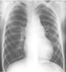 Gambar 13. Jantung sedikit membesar, a. pulmonalis menonjol,  dan arkus aorta menonjol 