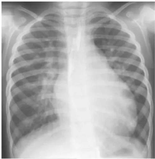 Gambar 14. PA: pembesaran jantung, konus pulmonalis  menonjol dan corakan bronkhovaskuler bertambah 