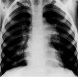 Gambar 15. Foto thorax pada anak dengan stenosis katup pulmonal . Arteri pulmonal  utama dan arteri pulmonal kiri mengalami pelebaran, tetapi varkularisasi paru dalam 