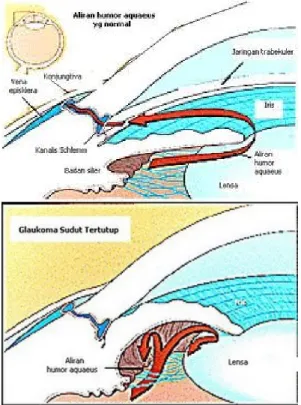 Gambar 1. Bilik mata depan normal (atas), dan sudut tertutup (bawah)