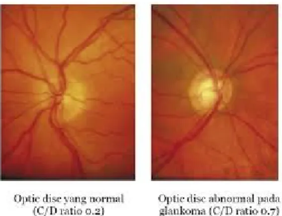 Gambar 4:   terlihat cup-disk ratio membesar akibat penggaungan saraf optik pada  funduskopi (kanan)