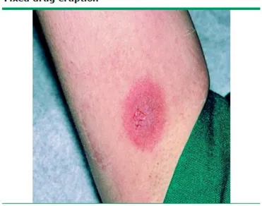 Gambar 6. Fixed drug eruption akibat tetracycline