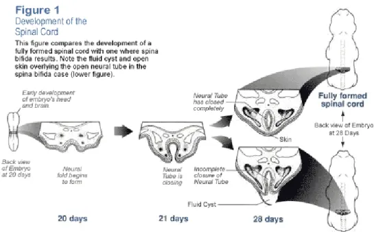 Gambar 2. Perbandingan proses embriologi spinal cord normal dan  spinal cord pada spina bífida
