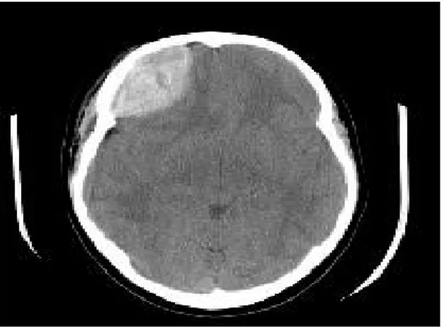 Gambar 1. Gambaran CT-Scan  Hematoma Epidural di Lobus Fronal kanan.