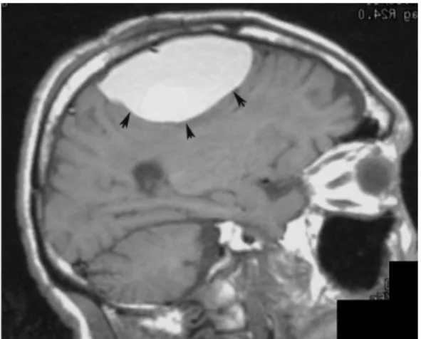 Gambar 3. Gambaran MRI Hematoma Epidural.