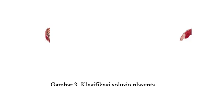 Gambar 3. Klasifikasi solusio plasentaGambar 3. Klasifikasi solusio plasenta