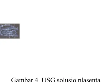 Gambar 4. USG solusio plasenta