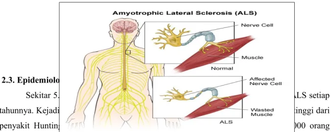 Gambar 2.2. Amyotrophic Lateral Sclerosis (ALS)